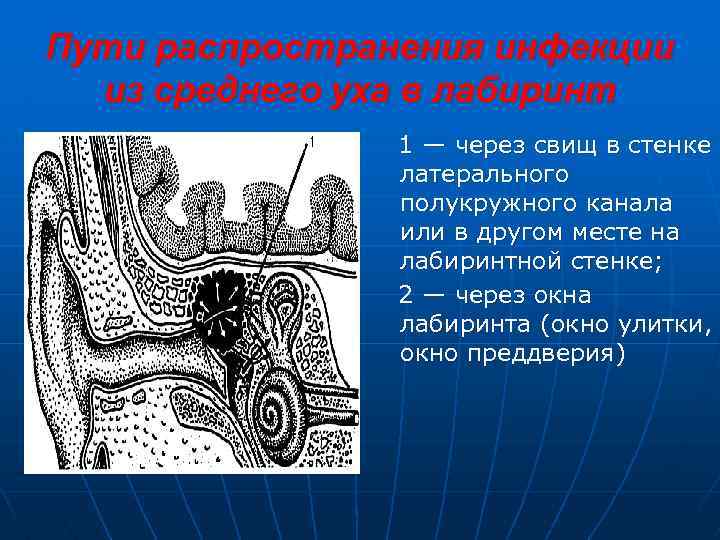 Пути распространения инфекции из среднего уха в лабиринт 1 — через свищ в стенке