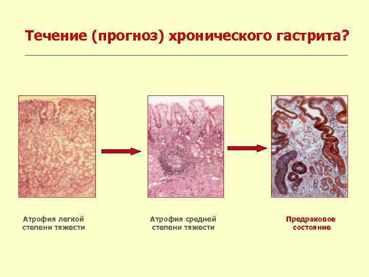Течение (прогноз) хронического гастрита? Атрофия легкой степени тяжести Атрофия средней степени тяжести Предраковое состояние