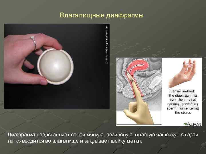 Влагалищные диафрагмы Диафрагма представляет собой мягкую, резиновую, плоскую чашечку, которая легко вводится во