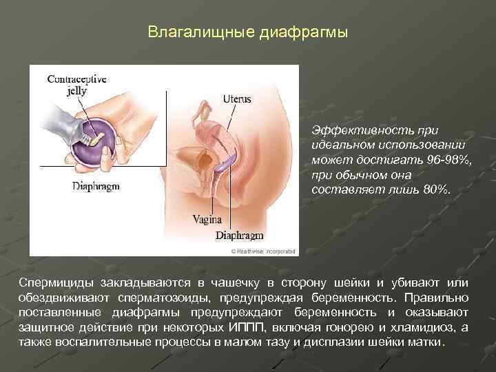Влагалищные диафрагмы Эффективность при идеальном использовании может достигать 96 -98%, при обычном она составляет