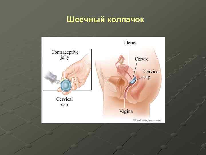 Шеечный колпачок 