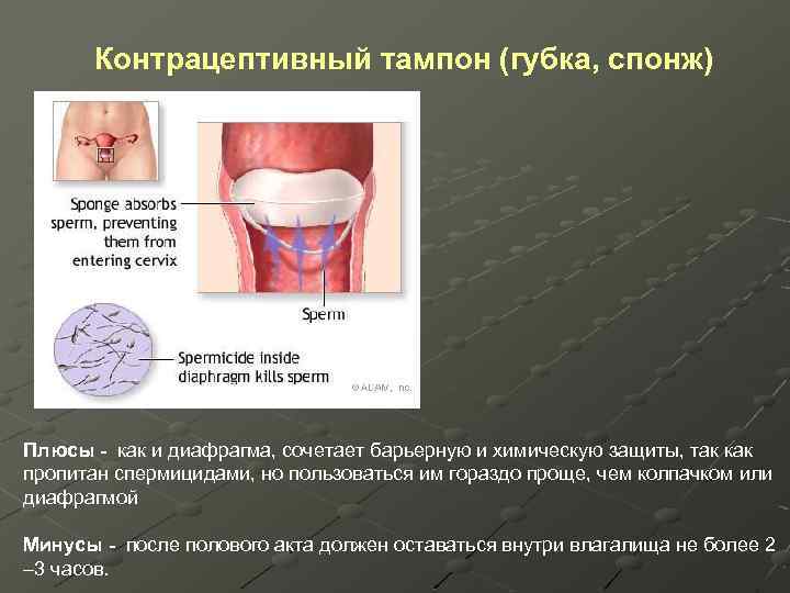 Контрацептивный тампон (губка, спонж) Плюсы - как и диафрагма, сочетает барьерную и химическую защиты,