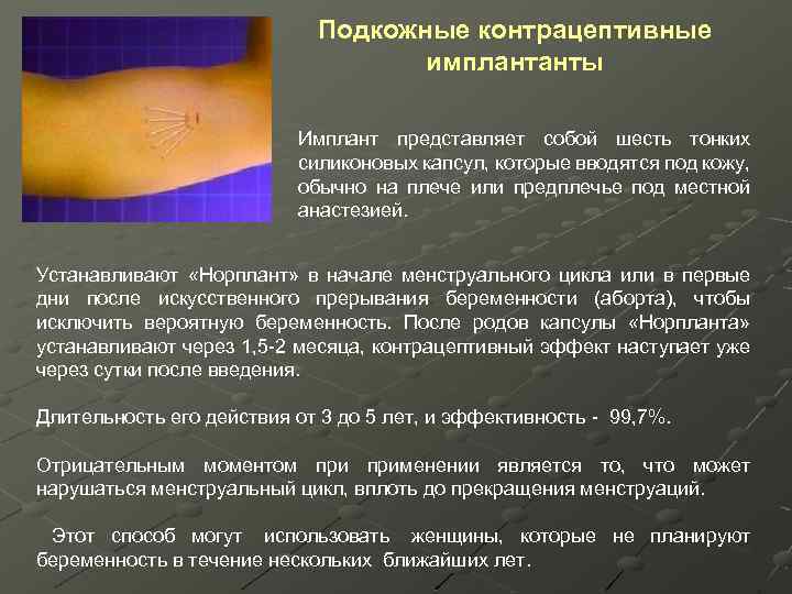 Подкожные контрацептивные имплантанты Имплант представляет собой шесть тонких силиконовых капсул, которые вводятся под кожу,