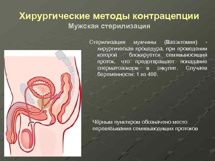 Хирургические методы контрацепции Мужская стерилизация Стерилизация мужчины (Вазэктомия) - хирургическая процедура, при проведении которой