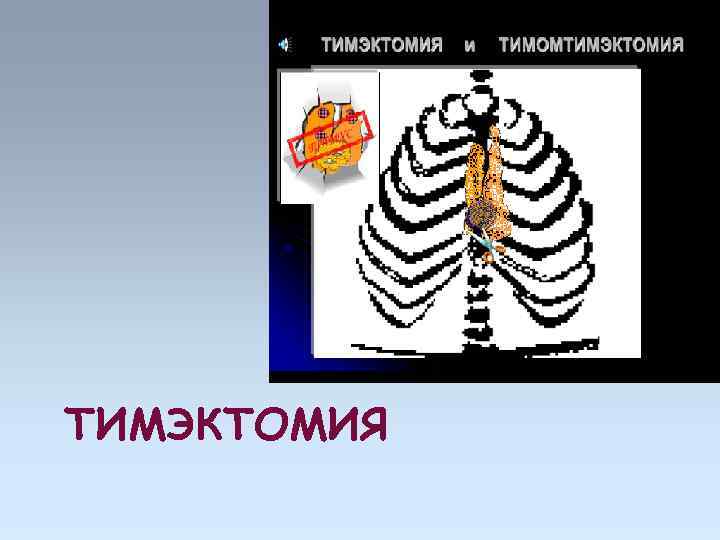 ТИМЭКТОМИЯ 