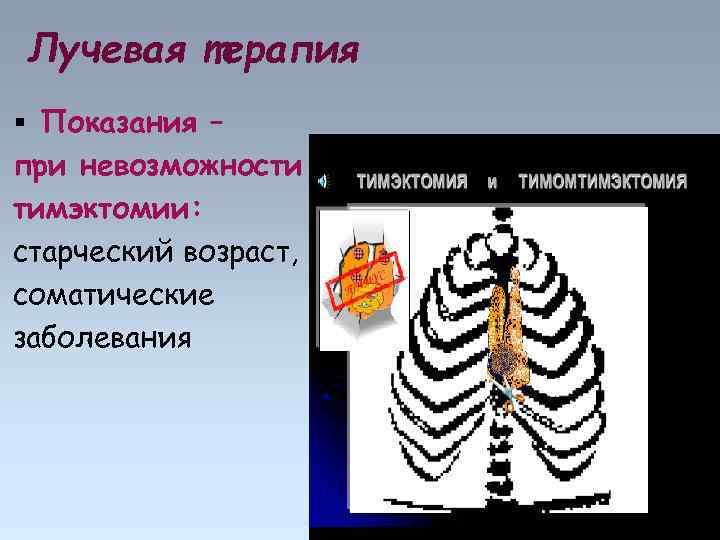 Лучевая терапия Показания – при невозможности тимэктомии: старческий возраст, соматические заболевания 