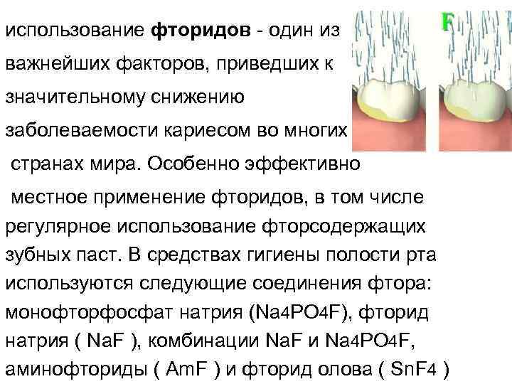 использование фторидов один из важнейших факторов, приведших к значительному снижению заболеваемости кариесом во многих