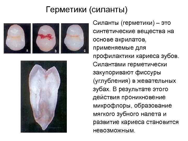 Герметики (силанты) Силанты (герметики) – это синтетические вещества на основе акрилатов, применяемые для профилактики