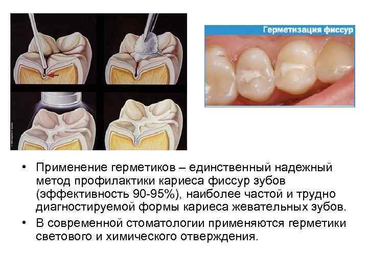 Фиссуры зубов схема