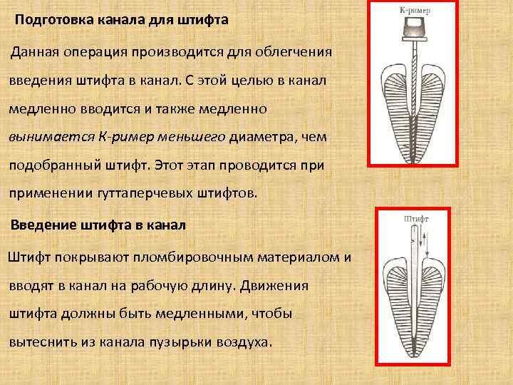 Подготовка канала для штифта Данная операция производится для облегчения введения штифта в канал. С