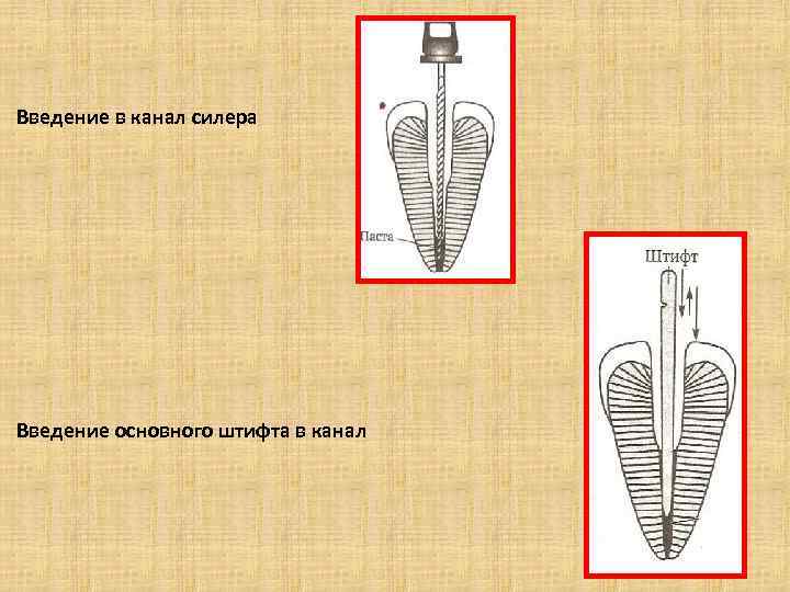 Введение в канал силера Введение основного штифта в канал 