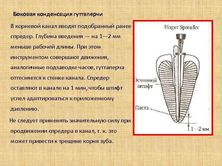 Пломбирование канала латеральной конденсацией