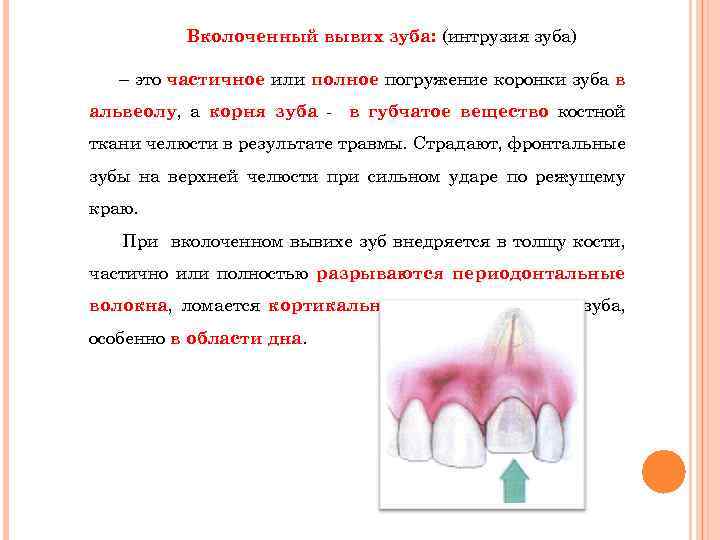 Вколоченный вывих зуба: (интрузия зуба) – это частичное или полное погружение коронки зуба в