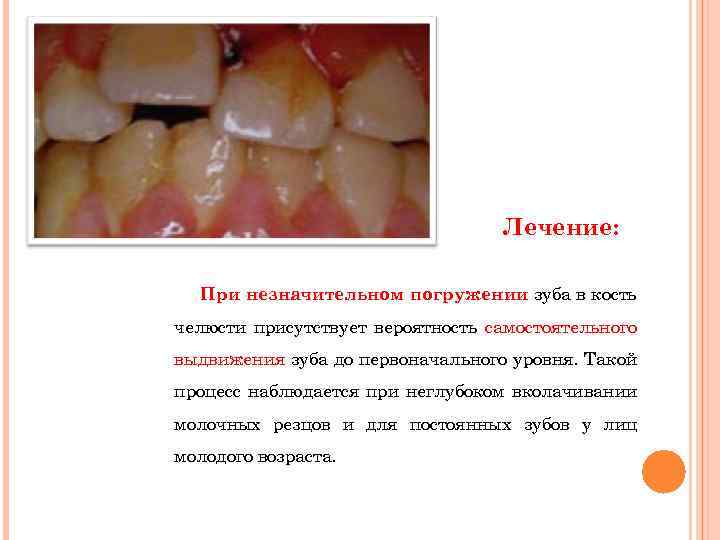 Лечение: При незначительном погружении зуба в кость челюсти присутствует вероятность самостоятельного выдвижения зуба до