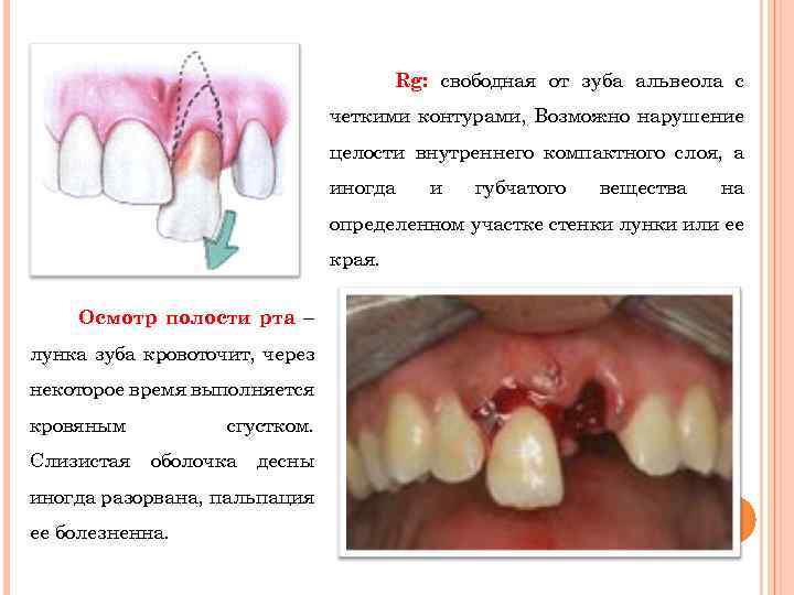 Rg: свободная от зуба альвеола с четкими контурами, Возможно нарушение целости внутреннего компактного слоя,
