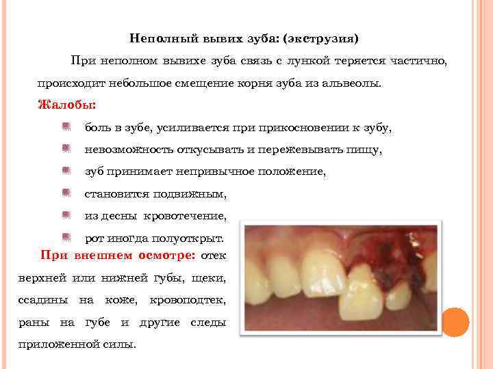 Неполный вывих зуба: (экструзия) При неполном вывихе зуба связь с лункой теряется частично, происходит