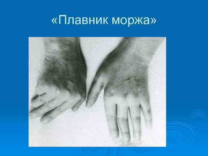  «Плавник моржа» 