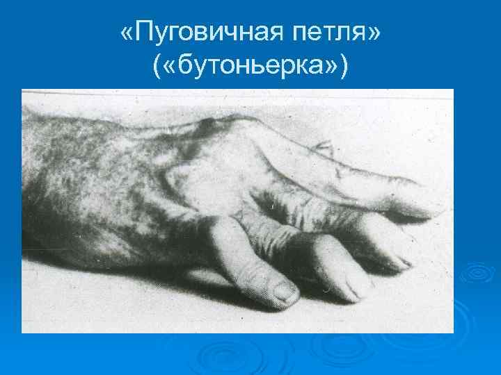  «Пуговичная петля» ( «бутоньерка» ) 