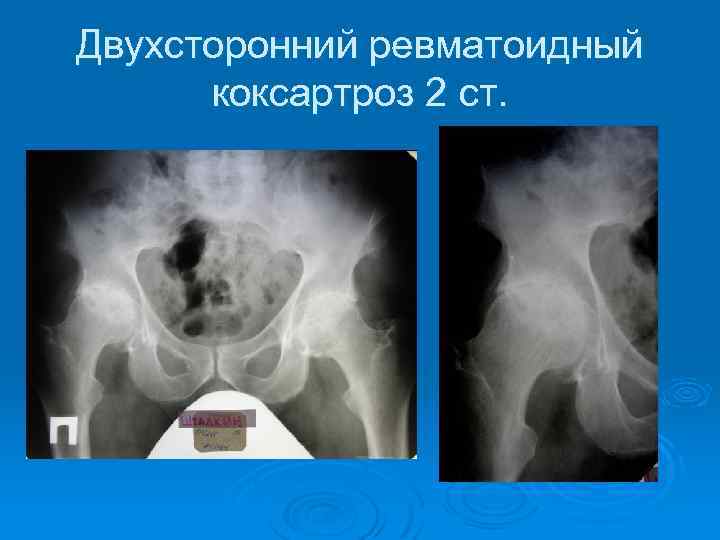 Двухсторонний ревматоидный коксартроз 2 ст. 