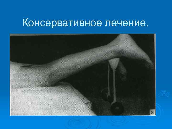 Консервативное лечение. 