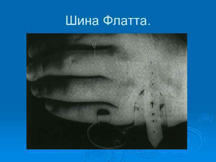 Шина Флатта. 