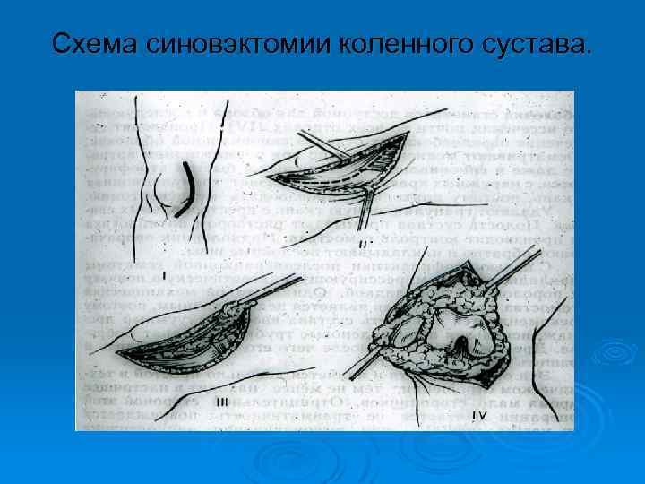 Схема синовэктомии коленного сустава. 