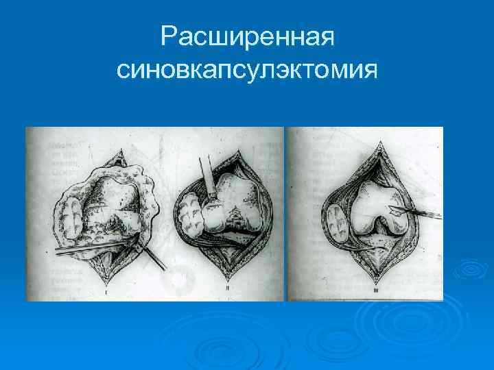 Расширенная синовкапсулэктомия 