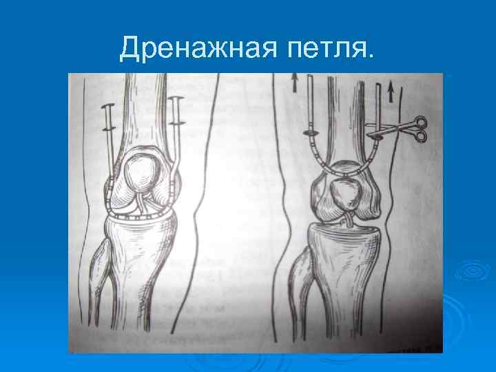 Дренажная петля. 