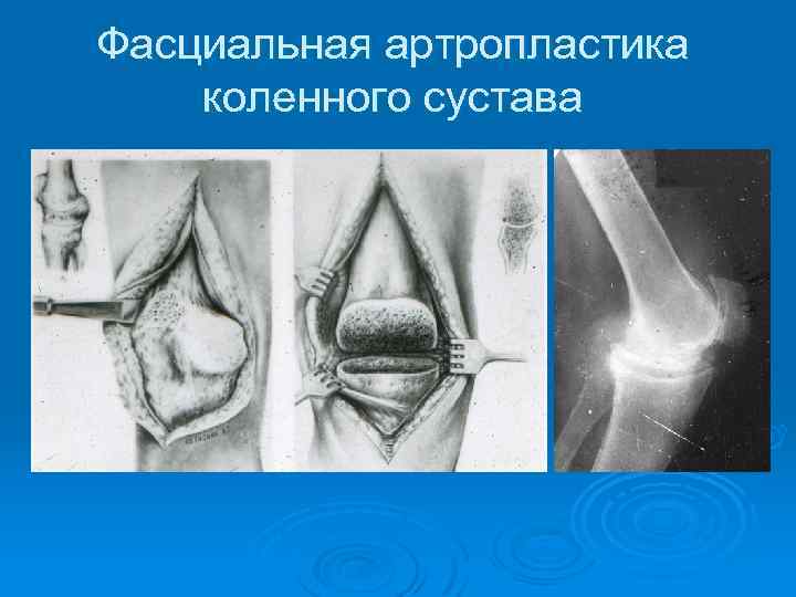 Фасциальная артропластика коленного сустава 