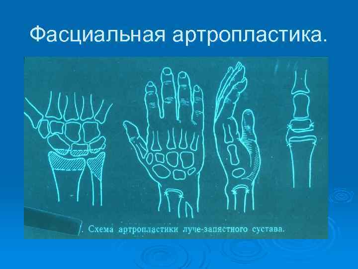 Фасциальная артропластика. 