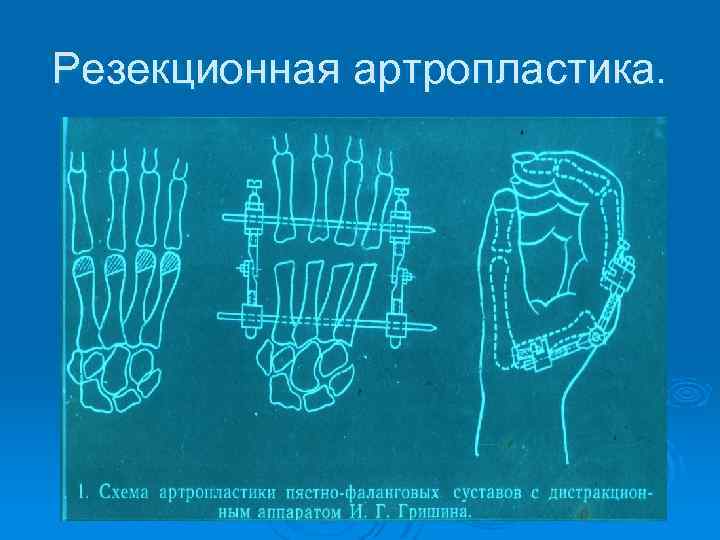 Резекционная артропластика. 