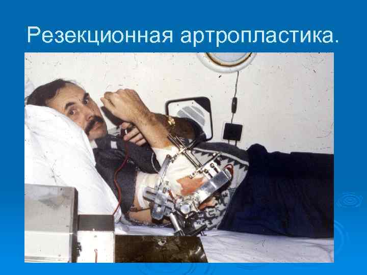 Резекционная артропластика. 