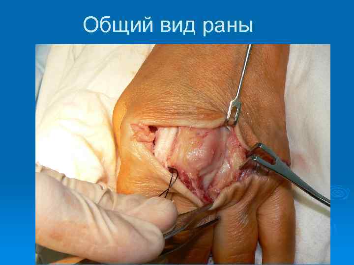 Общий вид раны 