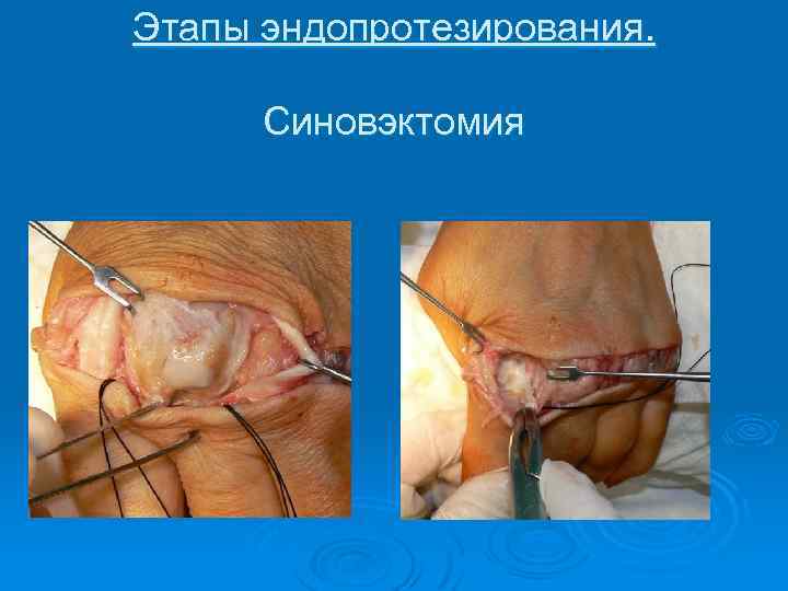 Этапы эндопротезирования. Синовэктомия 