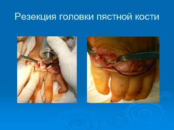 Резекция головки пястной кости 