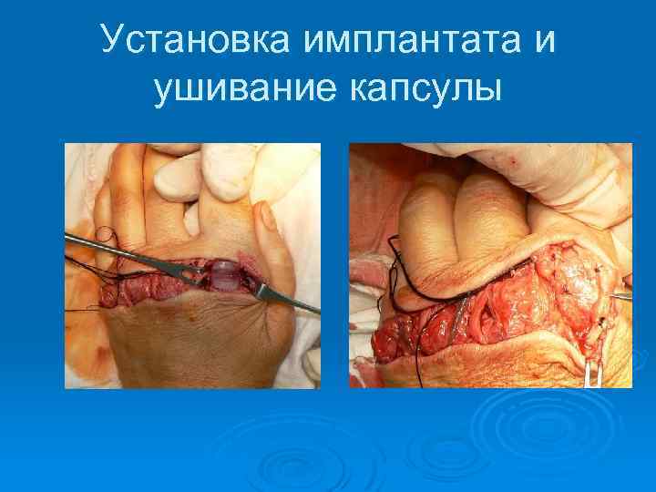 Установка имплантата и ушивание капсулы 