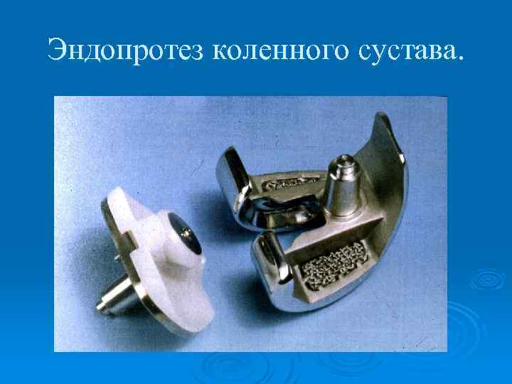 Эндопротез коленного сустава. 