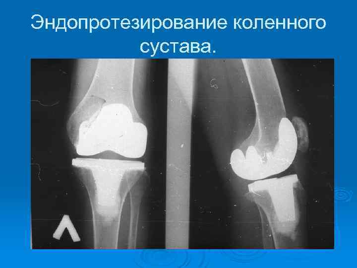 Эндопротезирование коленного сустава. 