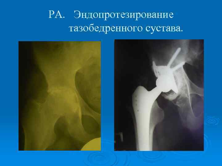 РА. Эндопротезирование тазобедренного сустава. 
