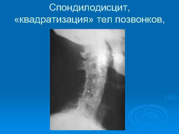 Спондилодисцит, «квадратизация» тел позвонков, 