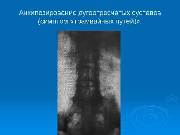 Анкилозирование дугоотросчатых суставов (симптом «трамвайных путей)» . 