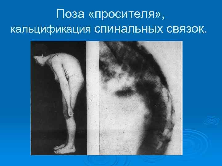 Поза «просителя» , кальцификация спинальных связок. 