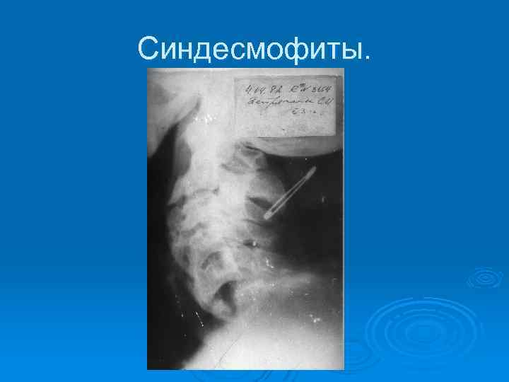 Синдесмофиты. 