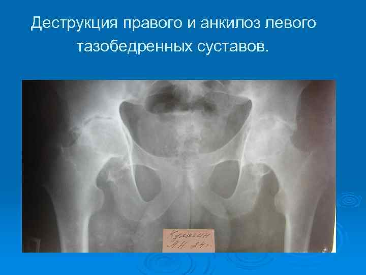 Деструкция правого и анкилоз левого тазобедренных суставов. 
