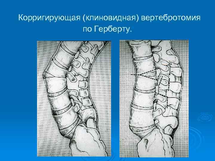 Корригирующая (клиновидная) вертебротомия по Герберту. 