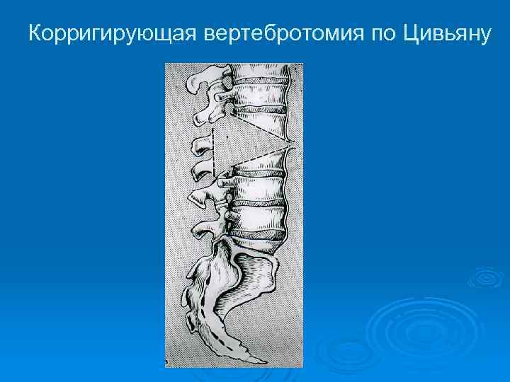 Корригирующая вертебротомия по Цивьяну 