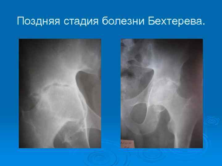 Поздняя стадия болезни Бехтерева. 