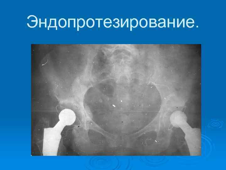 Эндопротезирование. 
