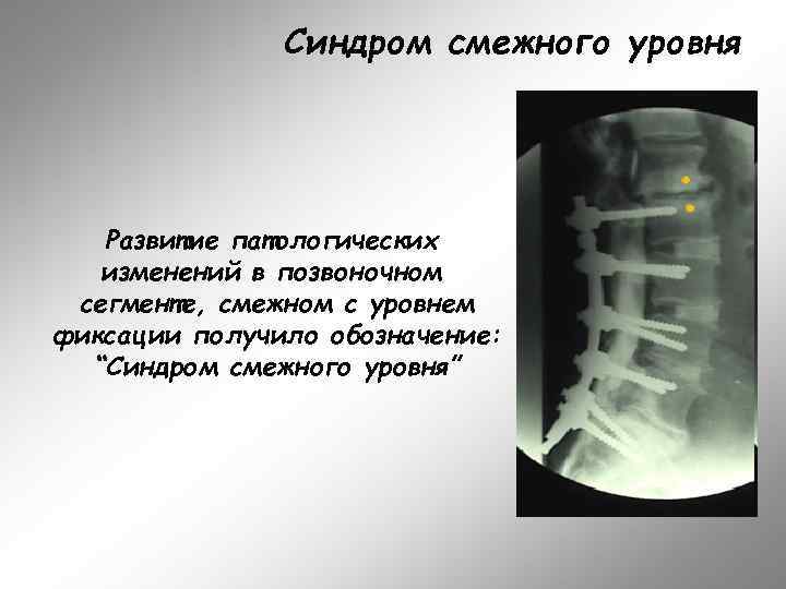 Синдром смежного уровня Развитие патологических изменений в позвоночном сегменте, смежном с уровнем фиксации получило