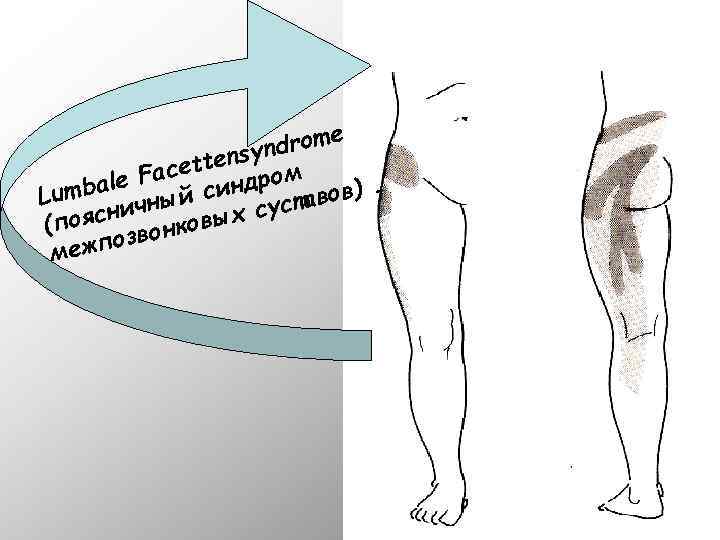 drome n tensy Facet ндром le. umba чный си L авов) т сни х